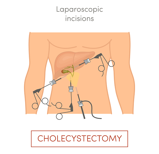 Cholecystectomy