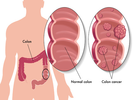 Bowel Cancer