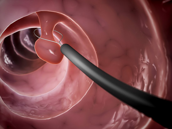 Colonoscopy