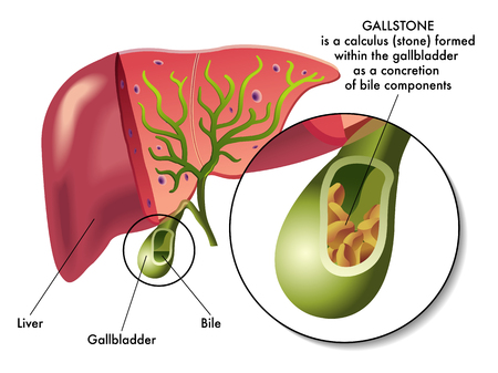 Gallstones and the Gallbladder