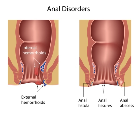 Haemorrhoids