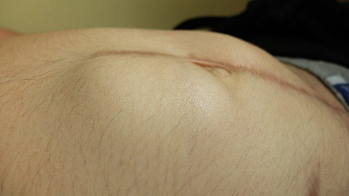Hernias
