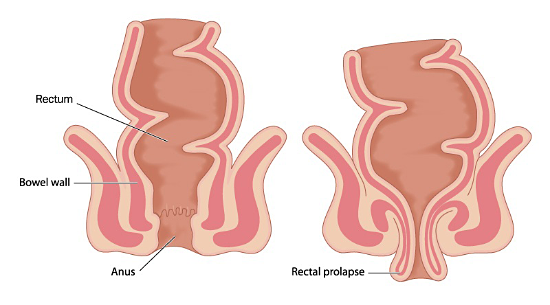 Rectal Prolapse