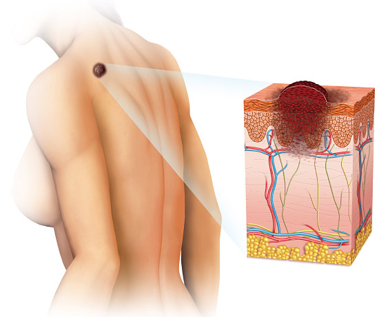 Skin Cancer